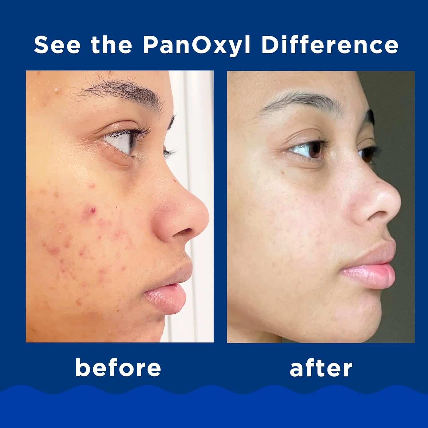 PanOxyl